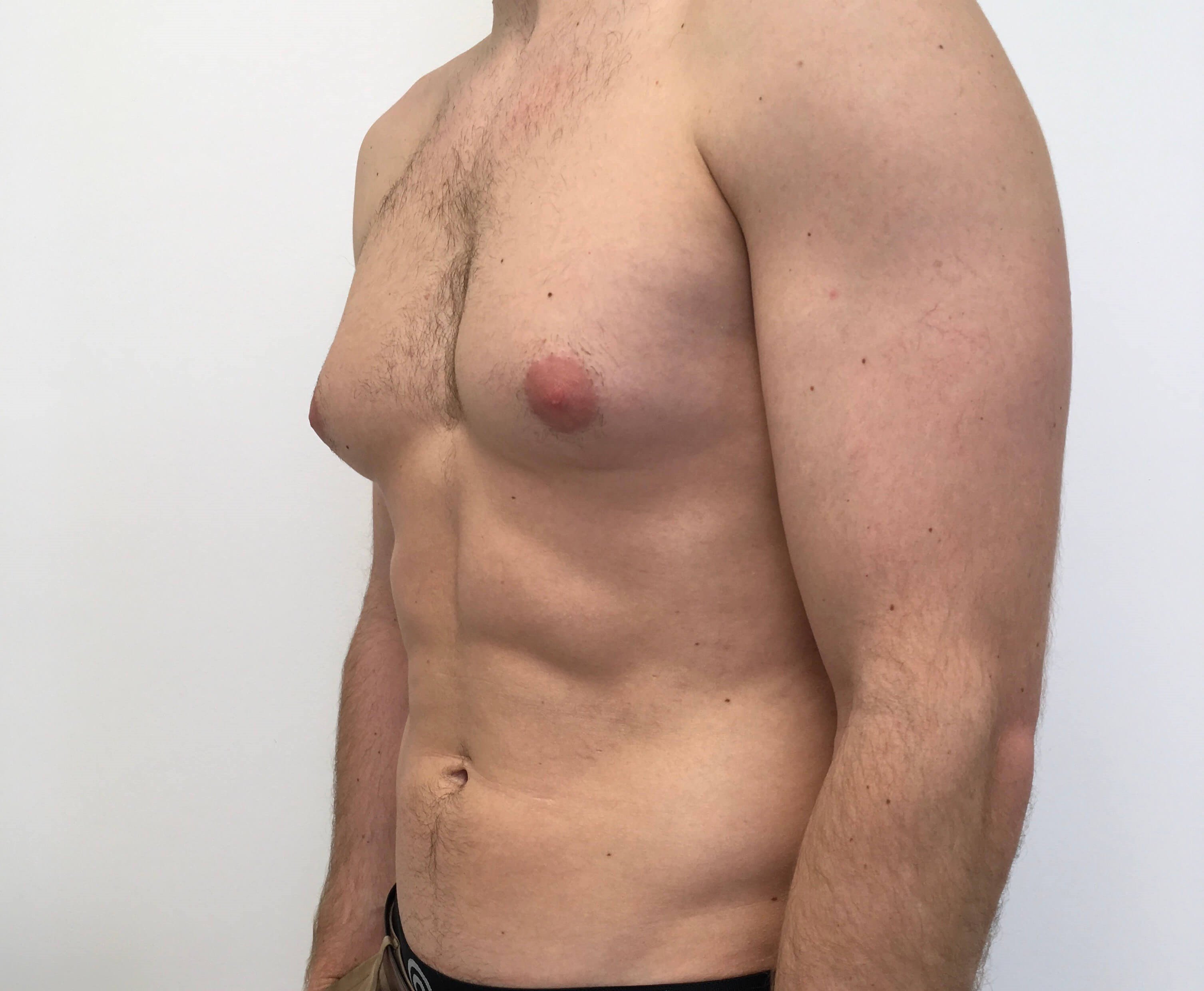 Male Breast Reduction FAQs: How Can I Get Rid of Gynecomastia Fast? featured image