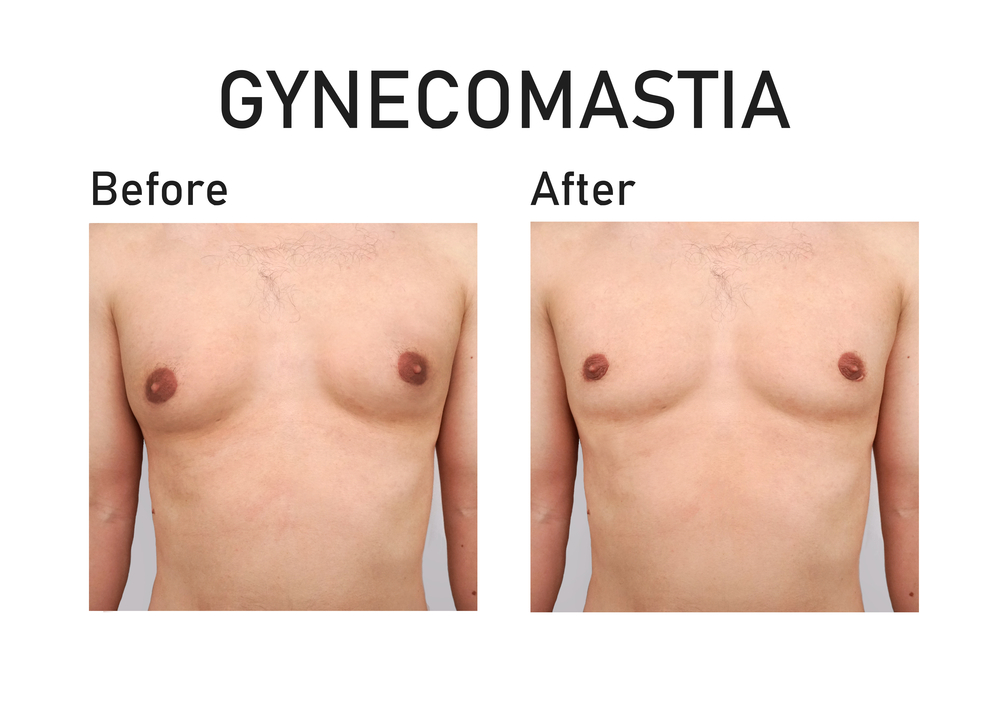 Who Is a Good Candidate for Male Breast Reduction? - Folsom Ca